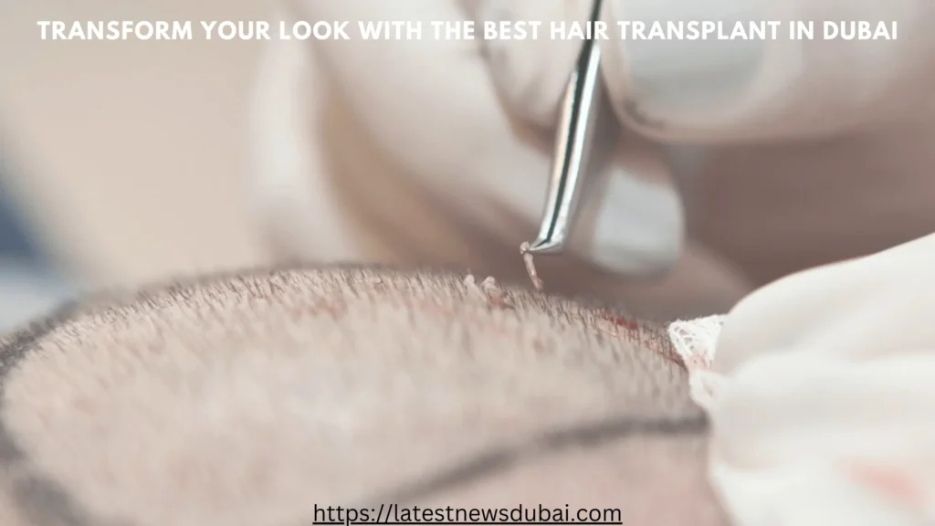 Best Hair Transplant in Dubai