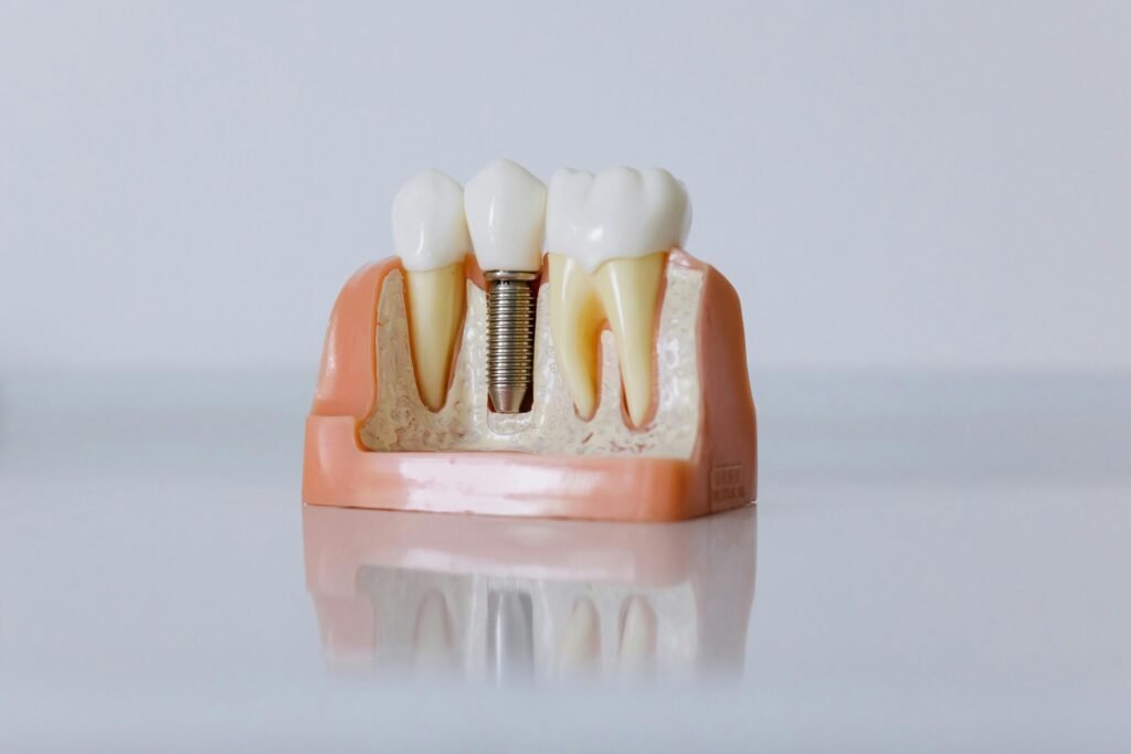 Dental Implants Vs. Dentures