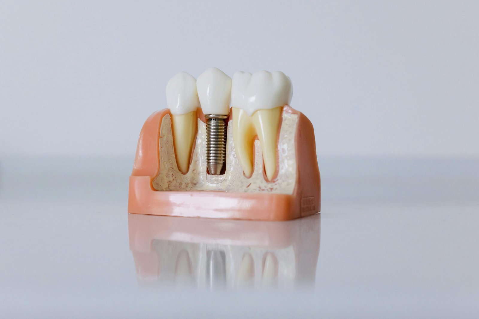 Dental Implants Vs. Dentures